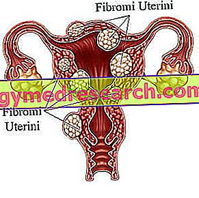 Kaalulangus parast emaka fibroidi