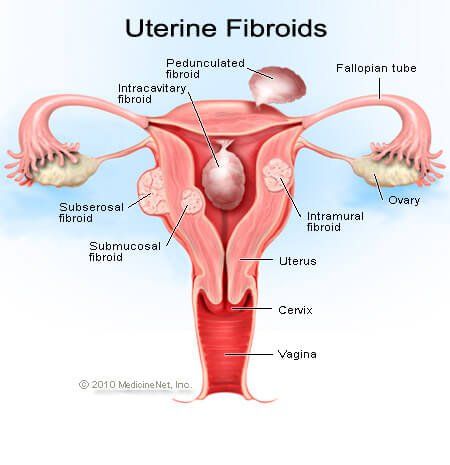 Kaalulangus parast emaka fibroidi